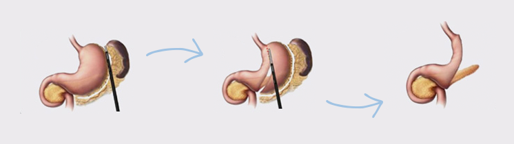 Procedimiento de gastrectomía en manga